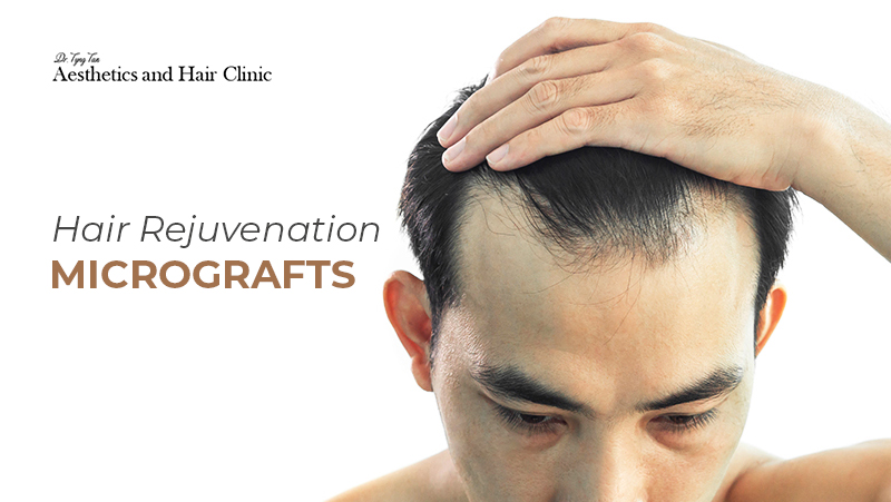 dtt hair rejuvenation micrograft