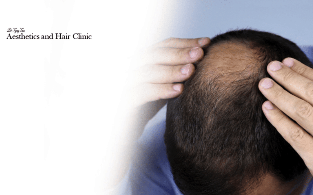 Insights On Hair Loss Treatments In Singapore